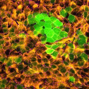 Well-differentiated small airway epithelial cells infected with recombinant human respiratory syncytial virus expressing enhanced green fluorescent protein at 3 days post-infection. Green, recombinant human respiratory syncytial virus; orange, acetylated α-tubulin (cilia) ; magenta, zona occludens 1 (tight junctions). 40x magnification. Courtesy of Laurine Rijsbergen, Department of Viroscience, Erasmus Medical Center, Rotterdam, The Netherlands.