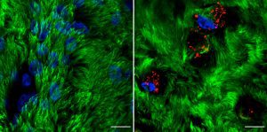 Rhinovirus C15 (RV-C15) infection of well-differentiated human bronchial epithelial cells cultured in air-liquid interface (hBEC-ALI) fixed at 12h post-infection (p.i.). A total of 50 μL of inoculum (PBS, left; or 1012 copies of RNA of RV-C15, right) was added onto the top of hBEC and incubated at 34C. The inoculum was removed 4 h p.i., and the cells were fixed at 12h p.i. with 4% paraformaldehyde. The indirect immunofluorescence assay was done using antibody against acetylated alpha-tubulin to detect motile cilia (#ab24610, Abcam; green-colored) and against dsRNA to detect the replicative intermediary forms of RV-C15 (#10010200, Scicons; red-colored); while the nuclei were stained with Hoechst 33342 (#H3570, Molecular Probes; blue-colored). The images were acquired using confocal microscopy (LSM710, Carl Zeiss Microscopy) at 630x magnification (scale bar = 10 μM). Courtesy of Talita Gagliardi, University of Maryland, College Park.